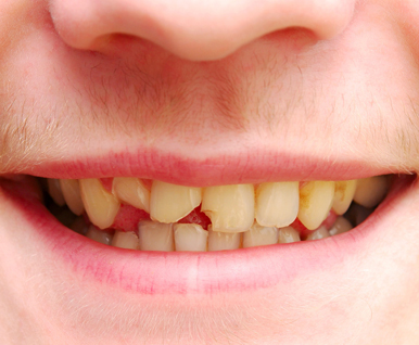 Broken Teeth Repair In India Fix Chipped/Broken Teeth Easily